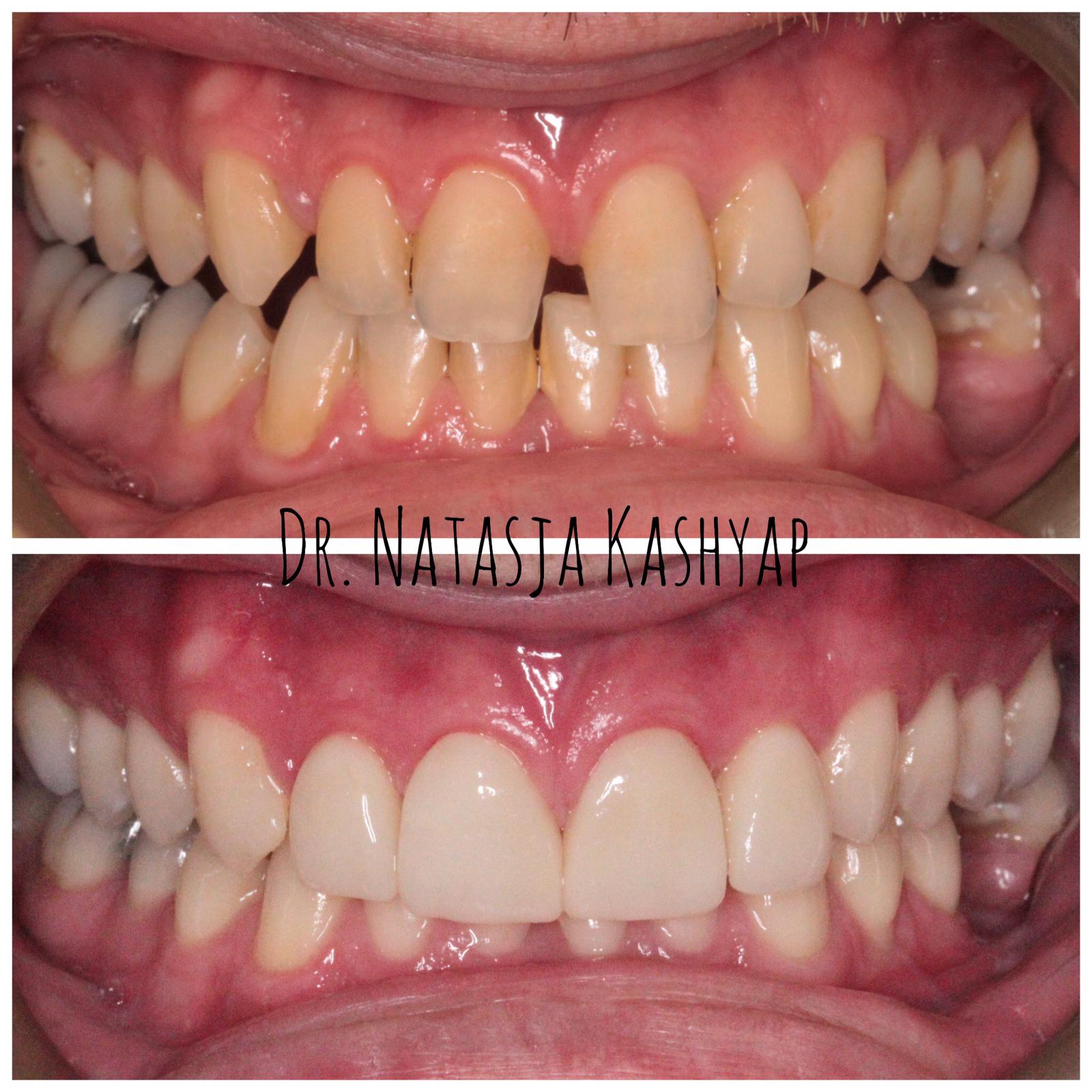 Teeth Whitening Gallery Brunner Court Dental & Implant Practice